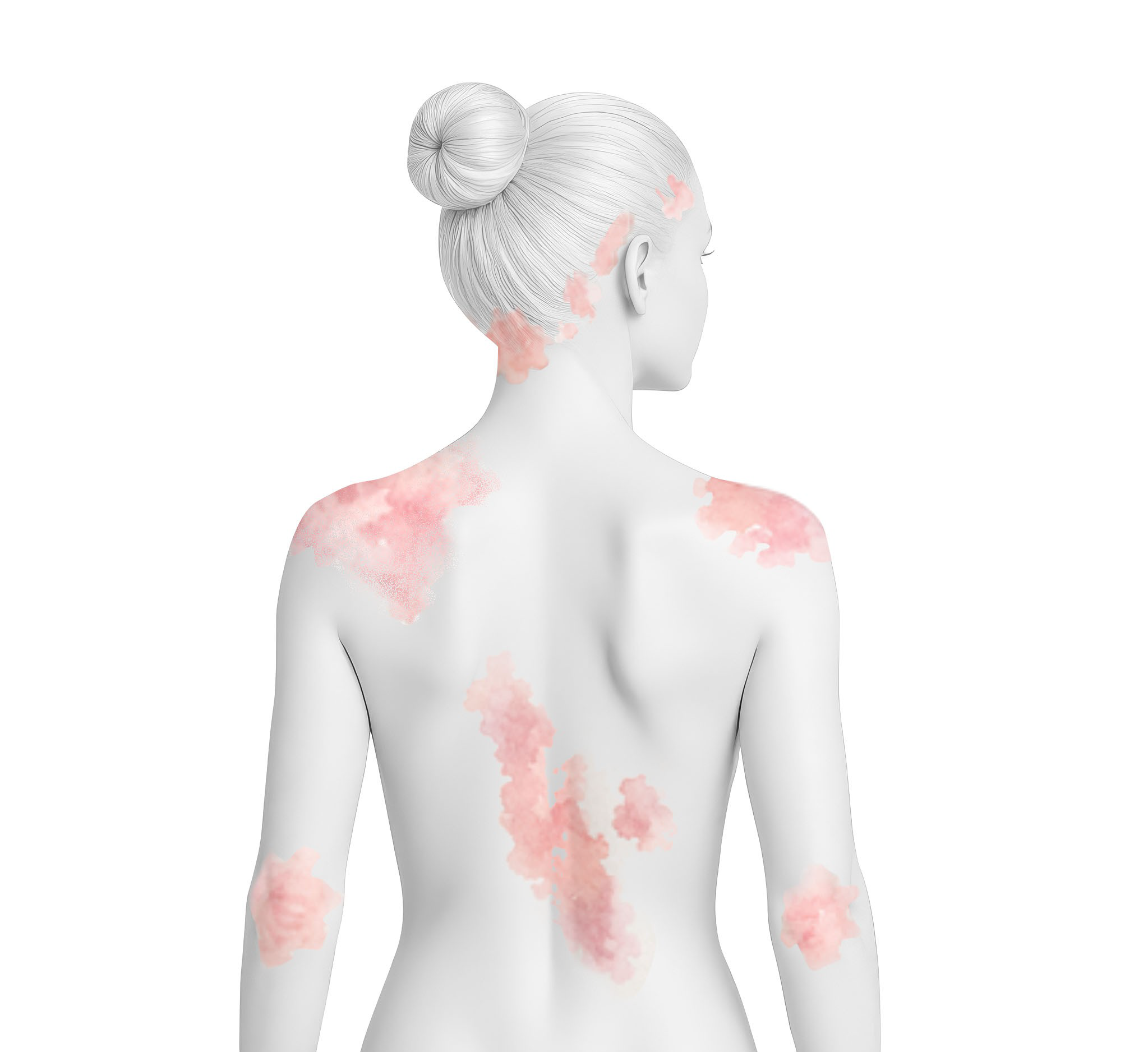 Medical illustration depicting plaque psoriasis lesions on the scalp, trunk, and extremities