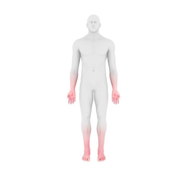 Chronic inflammatory demyelinating polyneuropathy illustration