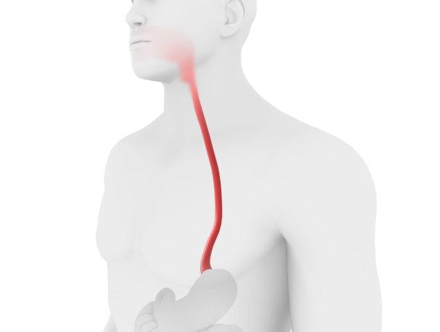 Eosinophilic esophagitis illustration