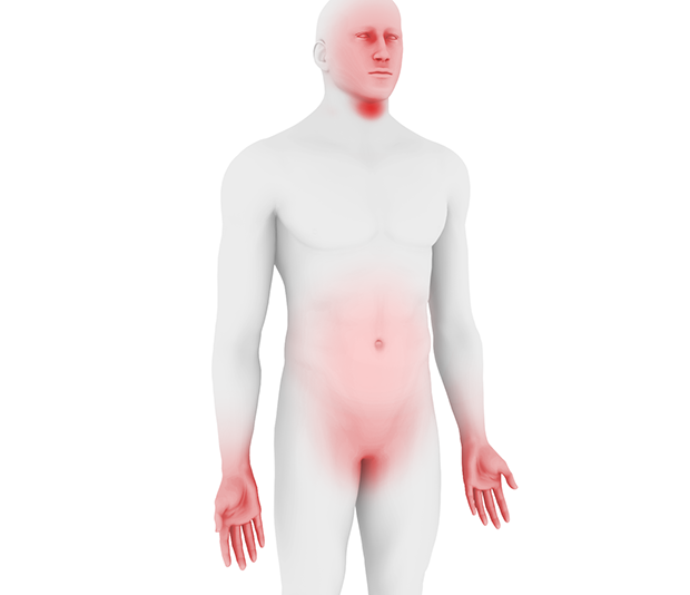 Hereditary Angioedema illustration