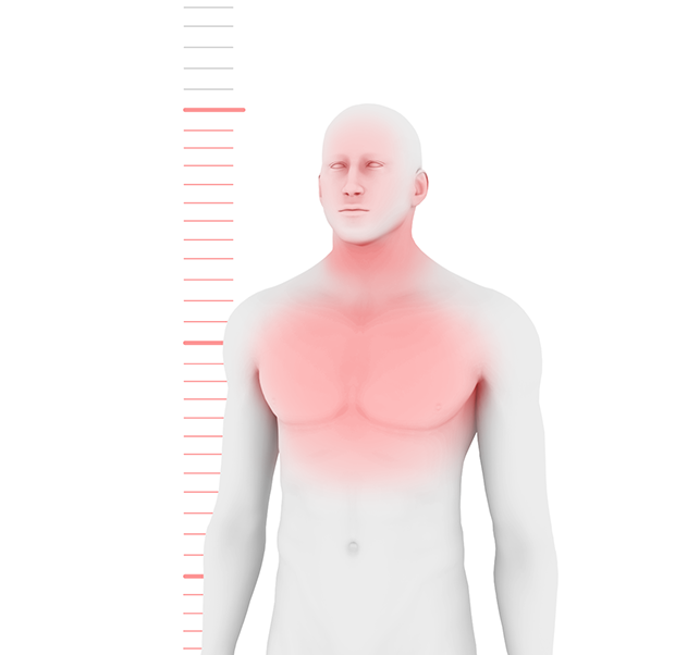 Hunter syndrome illustration