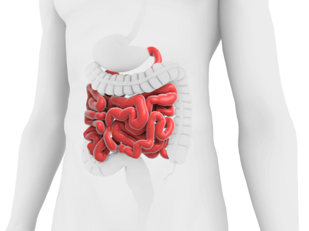 Short bowel syndrome illustration